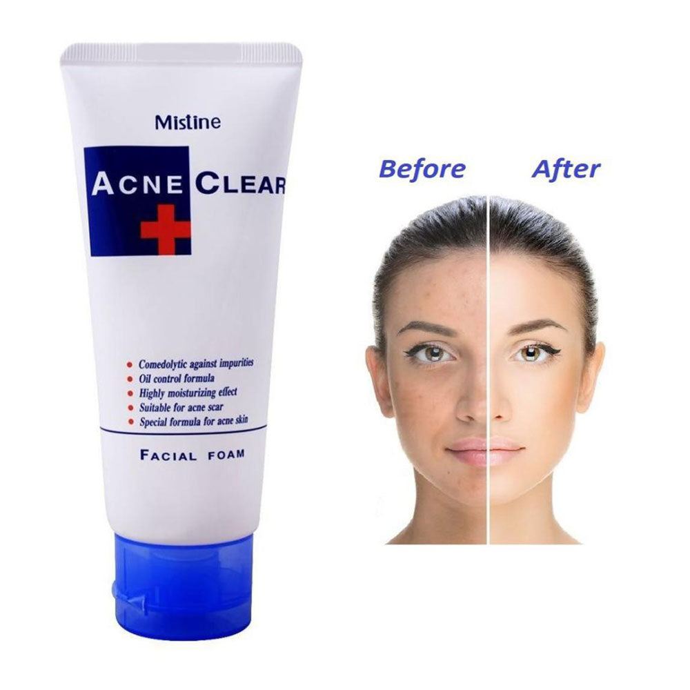 Mistine Acne Clear Facial Foam (Made in Thailand) 85g